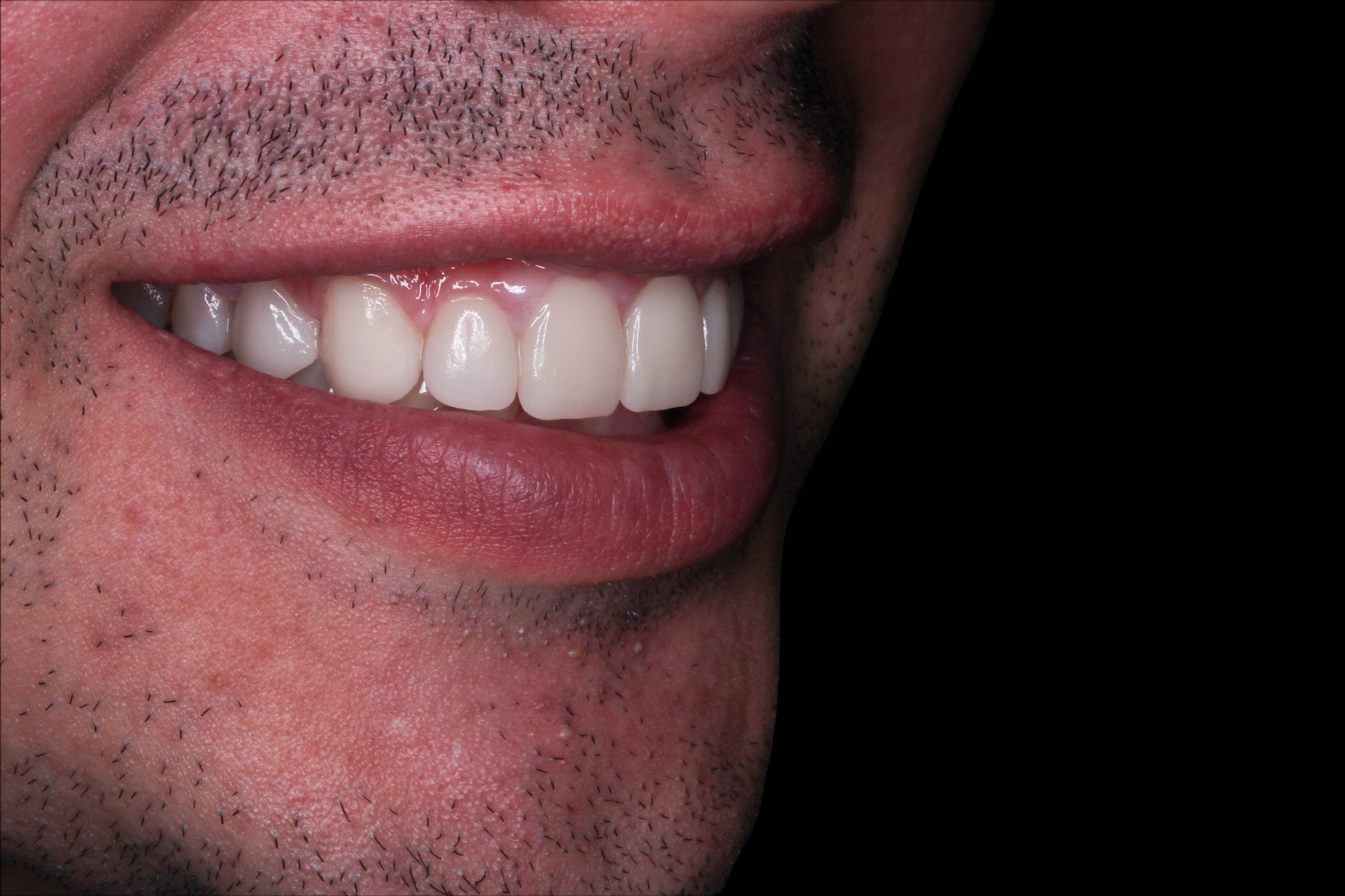 Después — diseño de sonrisa con 8 carillas de porcelana