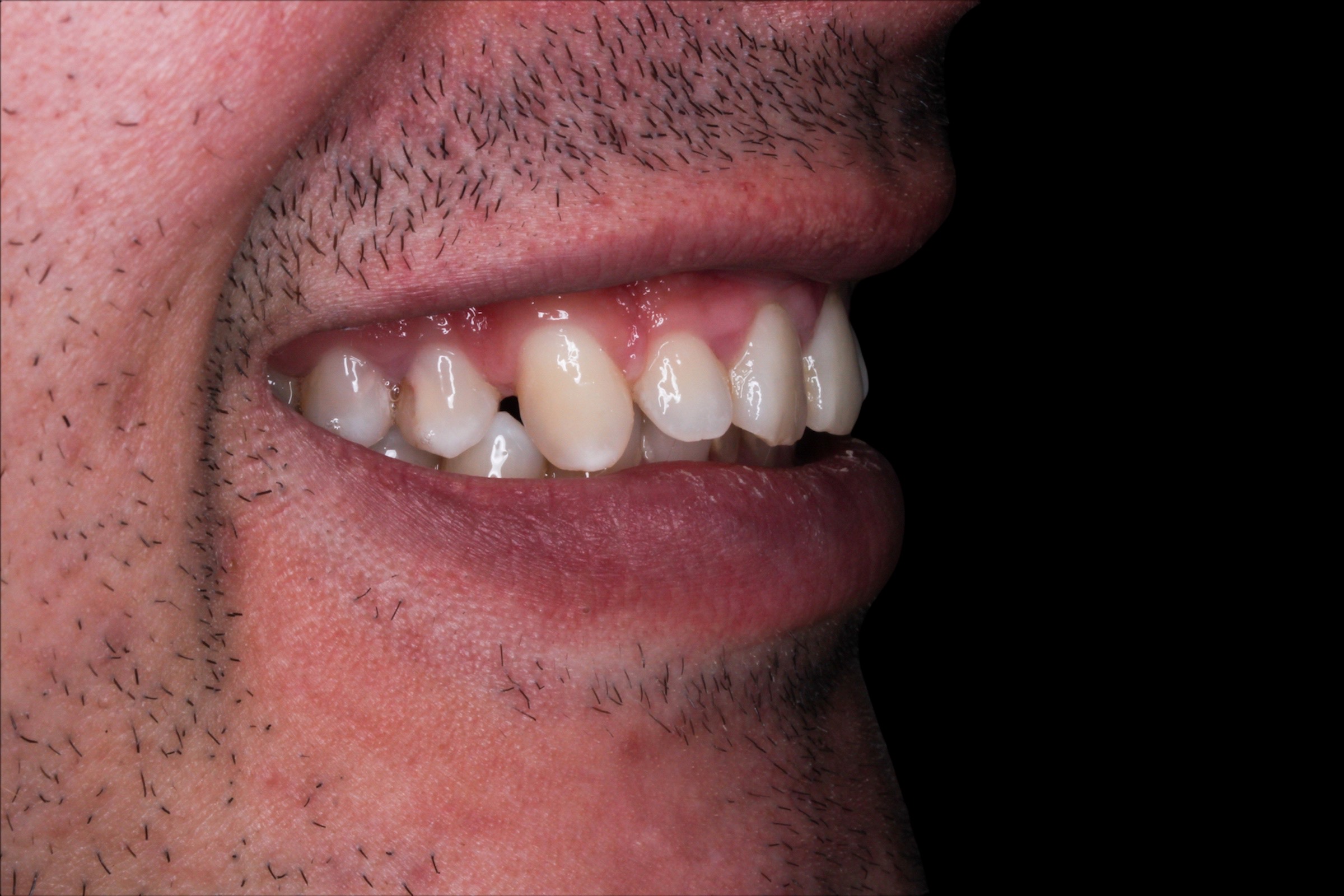 Antes — sonrisa original